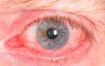 Красные глаза после наращивания ресниц: что делать и как лечить